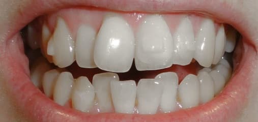 Close-up van een gebit met de aligner en attachments erop