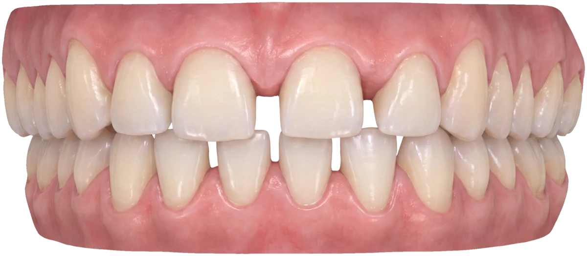 3D-scan van een gebit van voren, met zichtbare spleetjes tussen de boventanden en een duidelijke opening tussen de twee voorste snijtanden