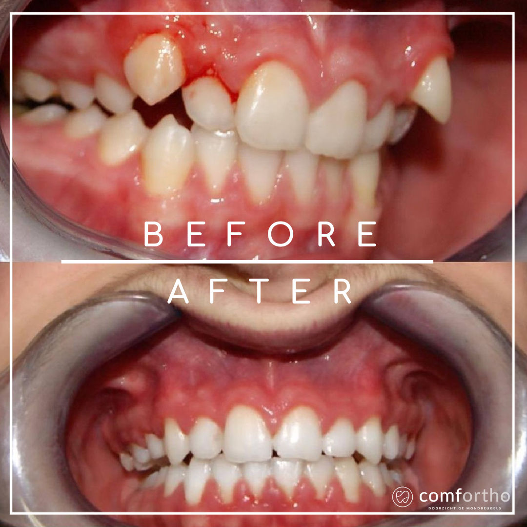 drempel Inzet Voorloper Invisalign Beugel Ervaringen - Comfortho, Smile Into Your Future :)