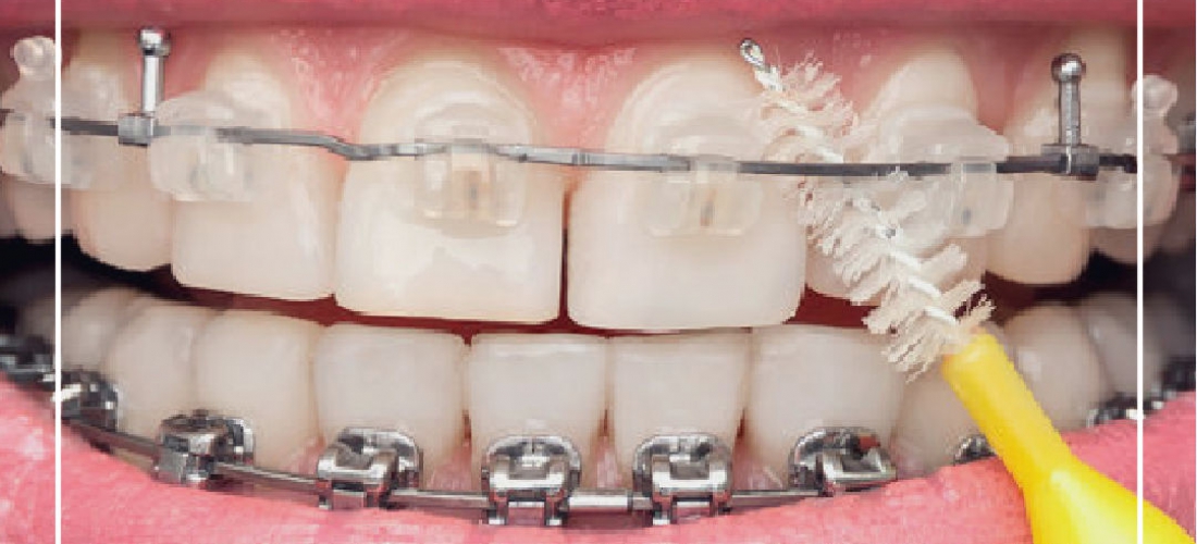 Tips & Trics How to Clean your Teeth with Braces