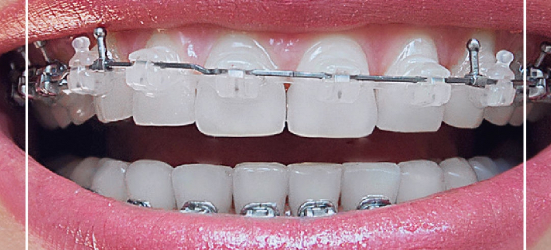 Metal braces, the side effects no one tells you and you should know.