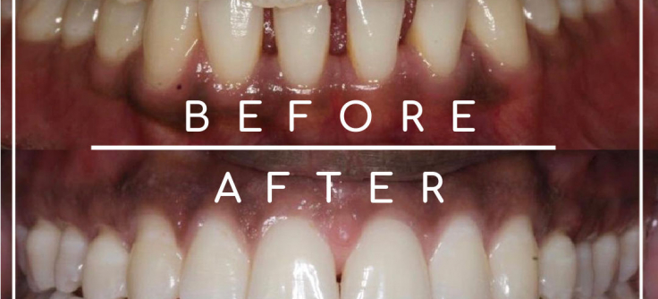 Verborgen Overgang stortbui Effectieve behandeling om spleetjes tussen jouw tanden te corrigeren.