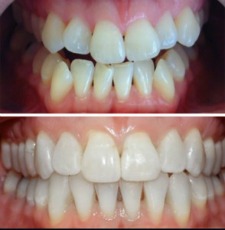 Keer terug paraplu pad Invisalign before and after - Comfortho, Smile Into Your Future :)