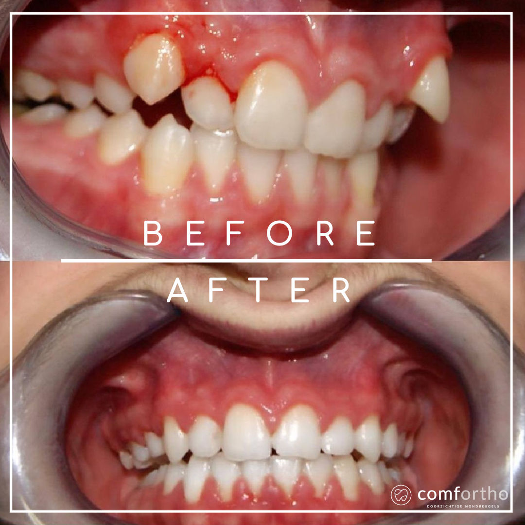 Keer terug paraplu pad Invisalign before and after - Comfortho, Smile Into Your Future :)